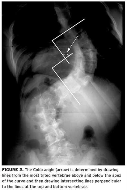 S Curve Scoliosis