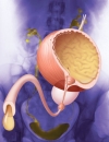 Overactive bladder cases woefully underdiagnosed