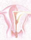 Heavy Menstrual Bleeding:<br>Assessing Impact, Evaluating Management Options