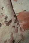 Dermatologic Look-Alikes: Vesiculobullous eruptions