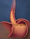 Raising the Bar in GERD Management:<br/>Optimizing Acid Control for Every Patient