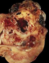 Efficacy and Safety of Everolimus Treatment in Metastatic Renal Cell Carcinoma
