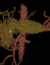 Preoperative Therapy for Patients with Resectable Adenocarcinoma of the Pancreatic Head