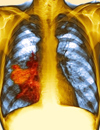 NonSmall Cell Lung Cancer Management based on EGFR Mutation Status
