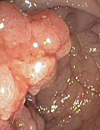 Colorectal Cancer and Evidence for Cure by Adjuvant Chemotherapy