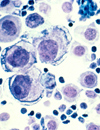 Evidence for the Use of Circulating Tumor Cells in the Prognostic Stratification of Women with Metastatic Breast Cancer