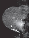 MRI Identifies Secondary Breast Cancers in Patients Eligible for Partial Breast Irradiation