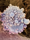 Adjuvant Chemotherapy and Radiation following PDD for Pancreatic Adenocarcinoma Summary of Trials and Future Directions
