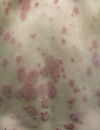 Dermatologic Look-Alikes: Erythematous truncal plaques
