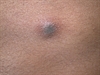 Dermatologic Look-Alikes: Purple eruptions