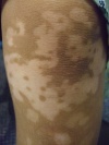 Dermatologic Look-Alikes: Hypopigmented Patches on the Body