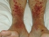 Dermatologic Look-Alikes: Red Rashes on the Lower Legs