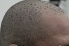 Scaly plaques spread from head to toe; Rash preceded by  fever and cough