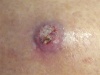 Dermatologic Look-Alikes: Enlarging Back and Shoulder Lesions