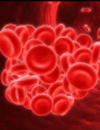 Preventing VTE in the Community: Best Practices for the Establishment & Management of an Outpatient VTE Prevention Program