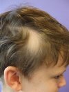 Dermatologic Look-Alikes: Patches of Hair Loss