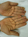 Prevention and Management of Hand-Foot Syndromes