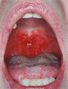 Case Study 2: A 29-Year-Old Female Teacher With Cold Sore Recurrences and Systemic Lupus Erythematosus