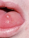 Oral Lesions Caused by Human Papillomavirus