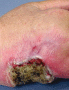 Nonhealing hand ulcer turns erythematous Keratotic palms paired with brittle nails