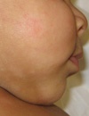 Infants with Hypopigmented Processes