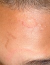 Pediatric Facial Rashes