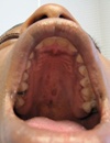 Atrophic facial plaques and palatal erosions Painful ulcers on the lips and tongue