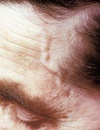 Treating Giant Cell Arteritis to Avoid Complications
