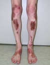 Itchy facial rash spread to back and chest Papules grow to cover patches below knees