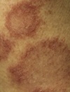 Painless, Annular Lesions