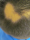 Hair Loss in an Adult and a Child