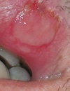 Persistent rash not affected by steroids Asymptomatic ulcer in a highrisk patient