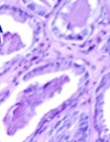 Relationships of Testosterone and Prostate Cancer: A 2011 Perspective