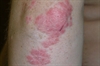 Mildly pruritic elbow and knee plaques; Hyperpigmented lesion returns to the palm