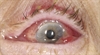 Therapeutic strategies for bacterial conjunctivitis
