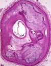 Cardiovascular Risk Assessment of the Asymptomatic Individual Beyond the Framingham Risk Score, the Use of Coronary Artery Calcium CAC and other Biomarkers