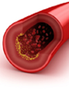 When Statins Are Not Enough: Residual Risk, Hyper TG Dyslipidemias, FH & LDL Apheresis