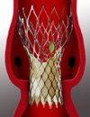 Transcatheter Aortic Valve Implantation TAVI