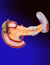 Management of Type II Diabetes and Cardiovascular Disease