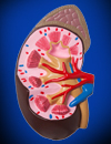Renovascular Hypertension
