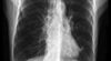 Dyspnea with comorbid heart failure and COPD