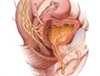 Urinary incontinence in the older female population