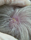 Facial rashes Macules spread to extremities Pink nodule on crown