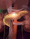 Chronic Pancreatitis