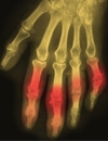 Clinical Challenges and Renal Considerations in Managing Gout: Part III