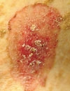 Asymptomatic red lesions Itchy papules on an infants torso and palms Pink scaly rash on the trunk and arms