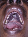 Oral Involvement of Systemic Diseases