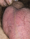 Infections, tumors, and lumps affecting the scrotal content