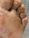 Erythematous scaling lesions Painful, itchy foot vesicles and bullae Enlarging annular plaques and patches
