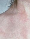Evaluating and managing pediatric food allergy